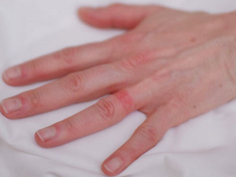 حساسیت بدلیجات مانند انگشتر
